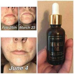 Hēli Miracle Oil - Skin Healing Oil - IN STOCK - 7 LEFT! - VALGINA.com